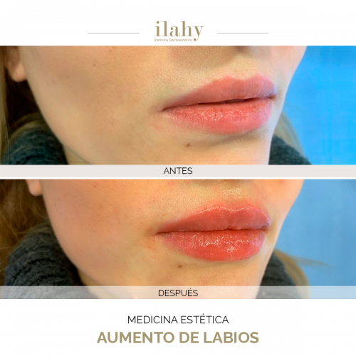 Aumento de labios